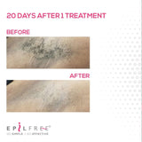 Epilfree Small Zone 12 Session Package